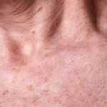 Aging female skin with melasma spots