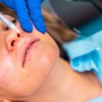 Woman receiving a botox injection to the lips